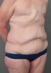 before lower body lift right front angle view case 3964