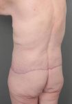 after lower body lift left angle back view case 3964
