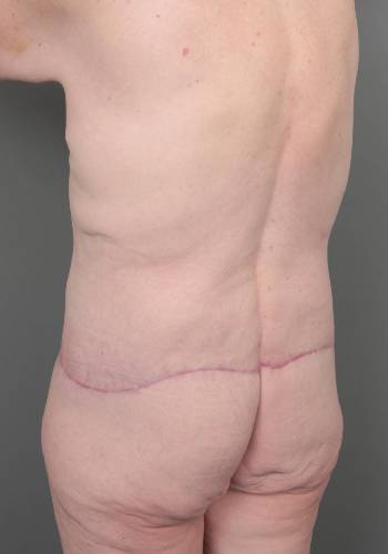 after lower body lift left angle back view case 3964
