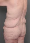 before lower body lift left angle back view case 3964