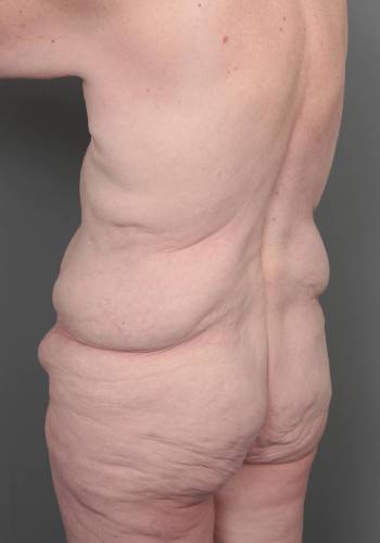 before lower body lift left angle back view case 3964
