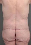 after lower body lift back view case 3964