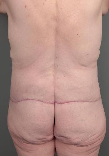 after lower body lift back view case 3964