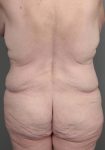 before lower body lift back view case 3964