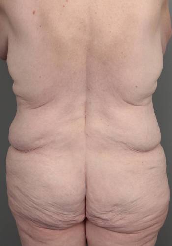 before lower body lift back view case 3964