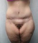 after lower body lift female patient front view case 3973