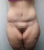after lower body lift female patient front view case 3973
