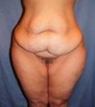 before lower body lift female patient front view case 3973