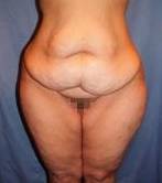 before lower body lift female patient front view case 3973
