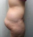 after lower body lift female patient right side view case 3973