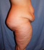 before lower body lift female patient right side view case 3973