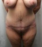 after lower body lift female patient front view case 3979