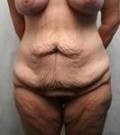 before lower body lift female patient front view case 3979