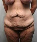 before lower body lift female patient front view case 3979