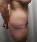 after lower body lift female patient right side view case 3979