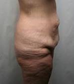 before lower body lift female patient right side view case 3979