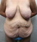 before lower body lift female patient front view case 3984