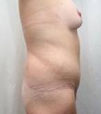 after lower body lift female patient right side view case 3984