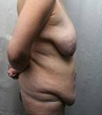 before lower body lift female patient right side view case 3984