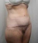 after lower body lift female patient right angle front view case 3989