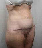 after lower body lift female patient right angle front view case 3989