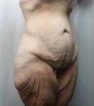before lower body lift female patient right angle front view case 3989