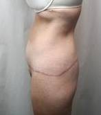 after lower body lift female patient left side view case 3989