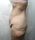 before lower body lift female patient left side view case 3989