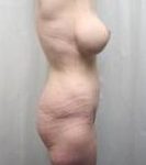 after lower body lift female patient right side view case 3994