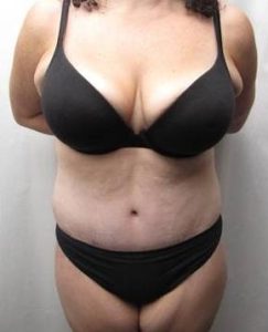 after lower body lift female patient front view case 3999