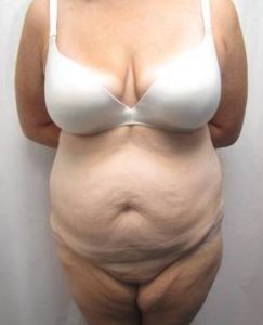 before lower body lift female patient front view case 3999