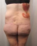 after lower body lift female patient back view case 3999