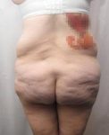 before lower body lift female patient back view case 3999