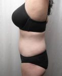 after lower body lift female patient left side view case 3999