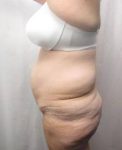 before lower body lift female patient left side view case 3999
