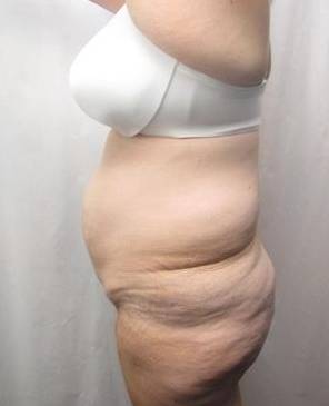 before lower body lift female patient left side view case 3999