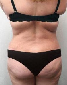 after lower body lift female patient back view case 4006