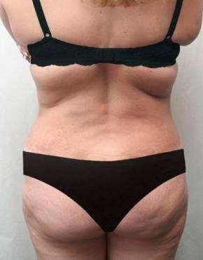 after lower body lift female patient back view case 4006