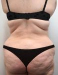before lower body lift female patient back view case 4006