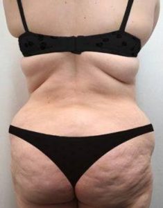 before lower body lift female patient back view case 4006