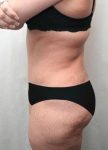 after lower body lift female patient left side view case 4006