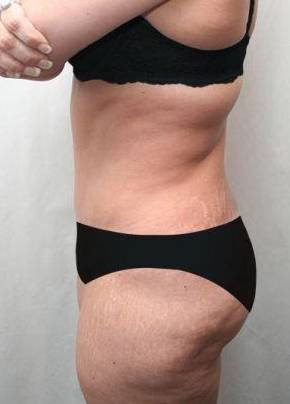 after lower body lift female patient left side view case 4006