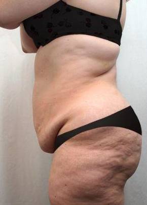 before lower body lift female patient left side view case 4006