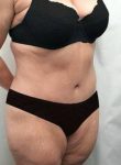 after lower body lift case female patient right front angle view case 4006