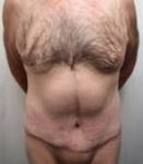 after lower body lift case male patient front view case 4013