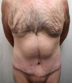 after lower body lift case male patient front view case 4013