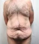 before lower body lift male patient front view case 4013