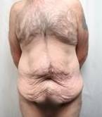 before lower body lift male patient front view case 4013