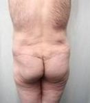 after lower body lift male patient back view case 4013