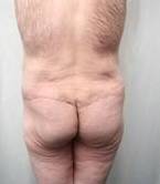 after lower body lift male patient back view case 4013